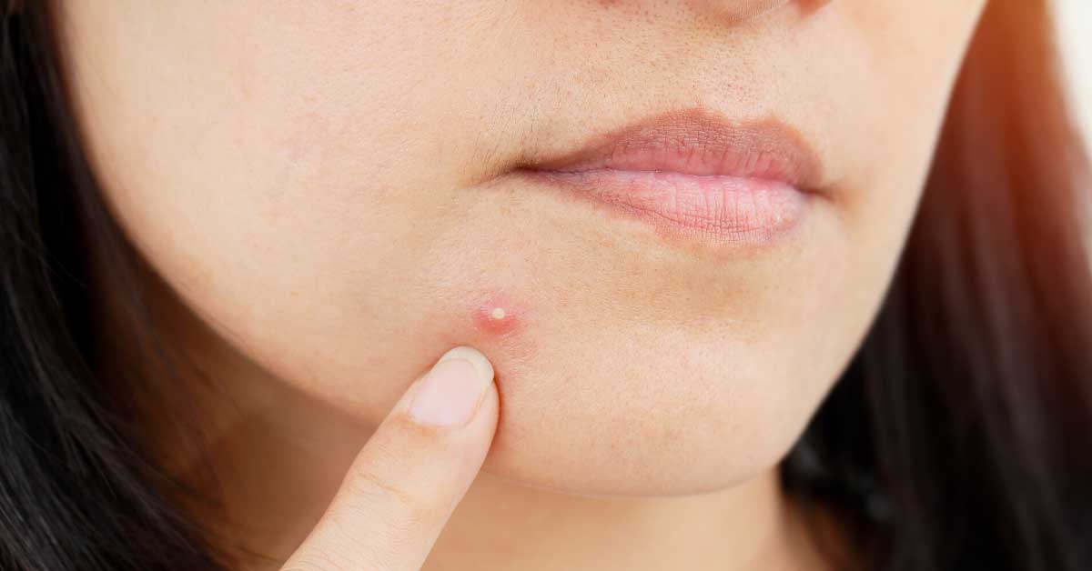  Gnojne bubuljice su odvratne, ali ima rešenja za njih!