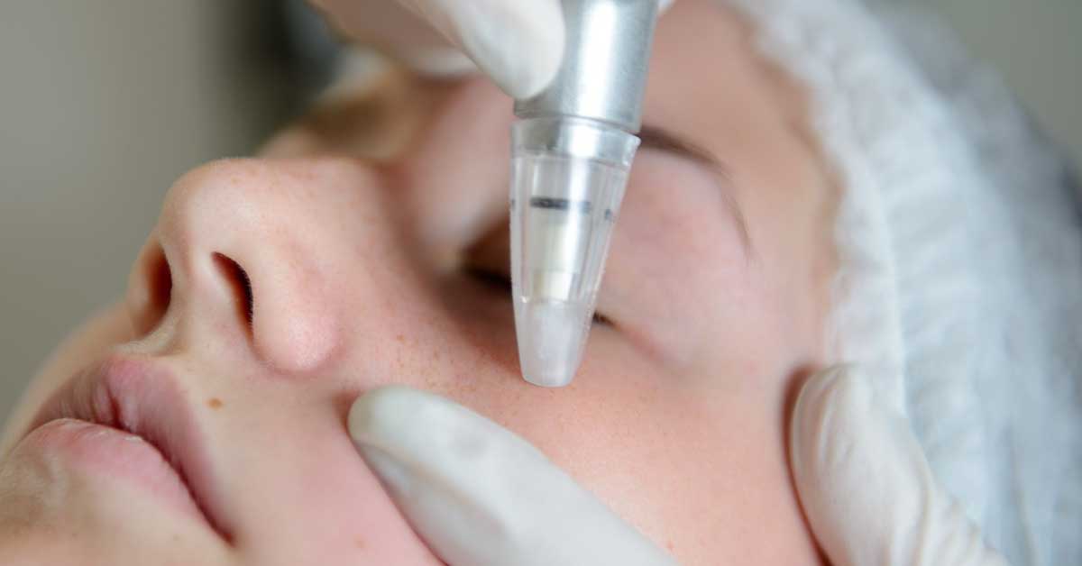 mikrodermoabrazija lica