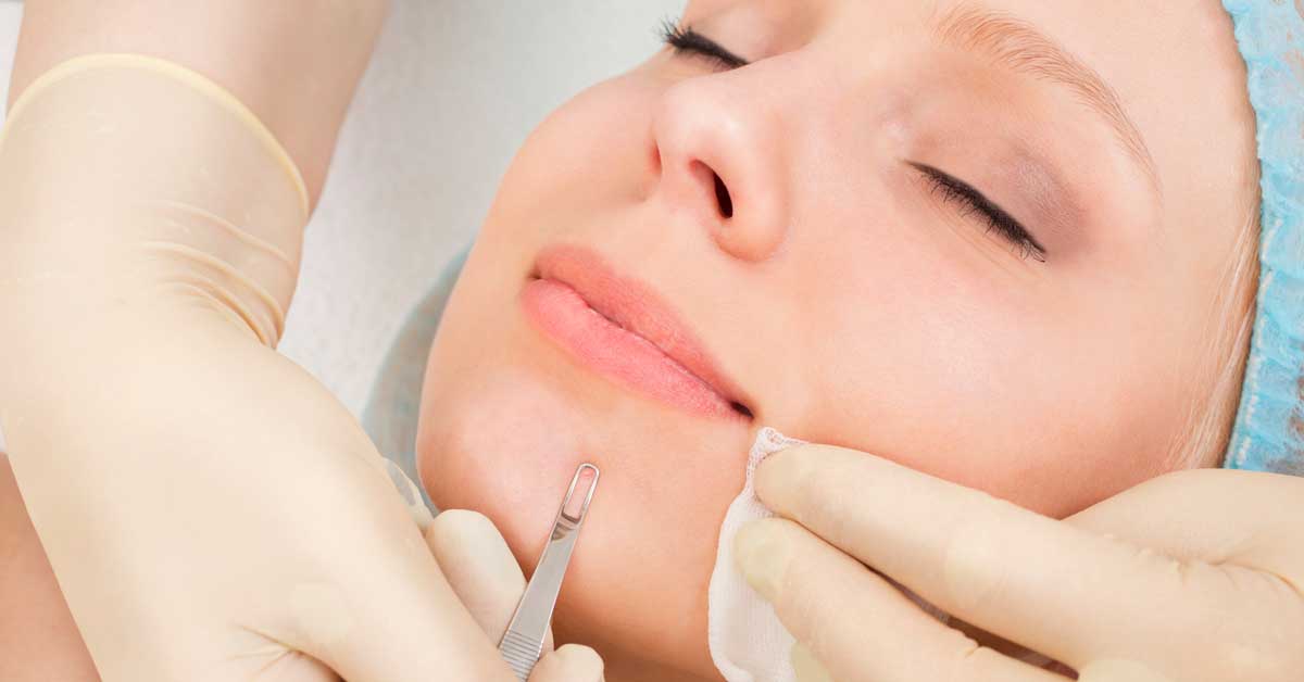  Komedokvečer – štapić za mitisere i njegova upotreba