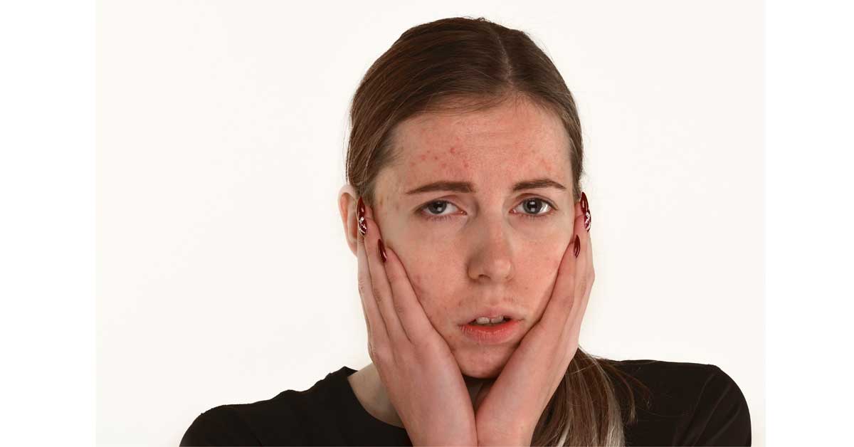  Kako ukloniti crvenilo od bubuljica na najbrži način?