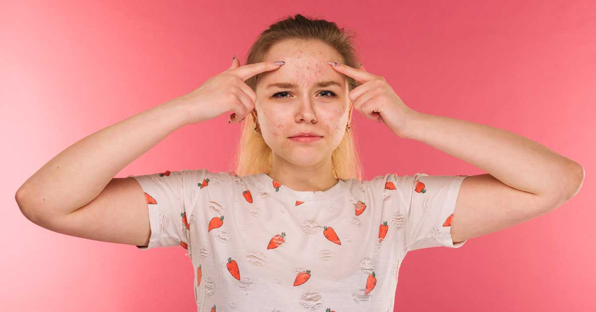 pubertetske bubuljice