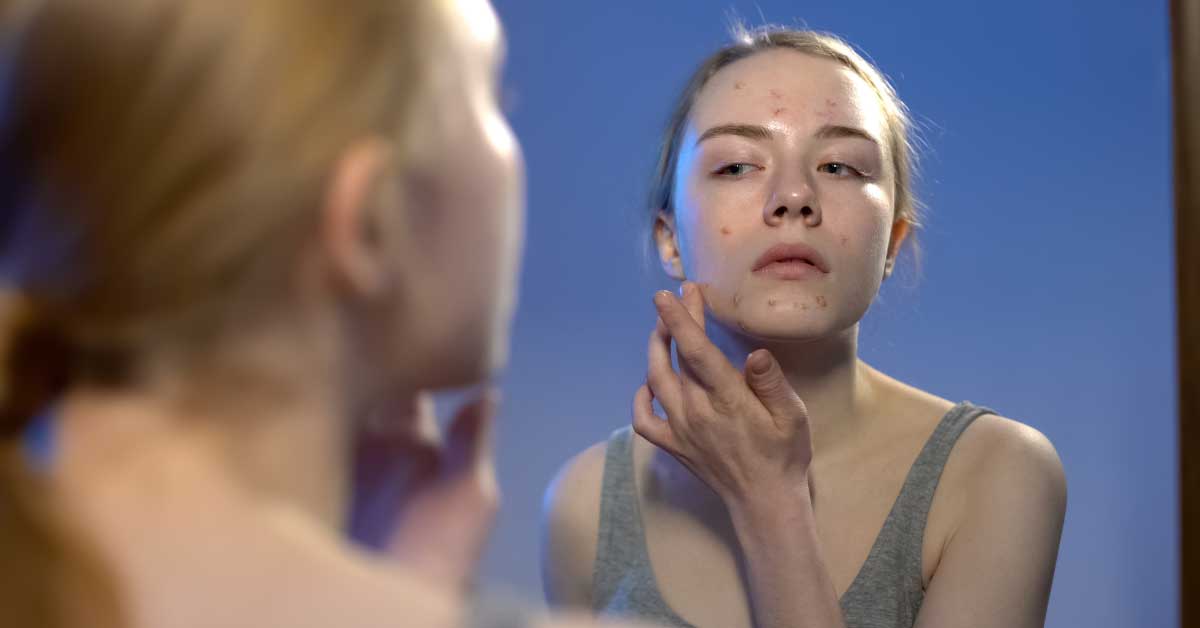  Najbolja krema za bubuljice – top lista