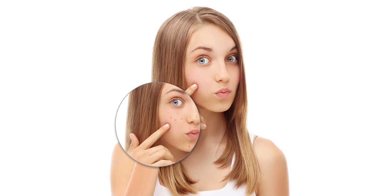 zarastanje bubuljica