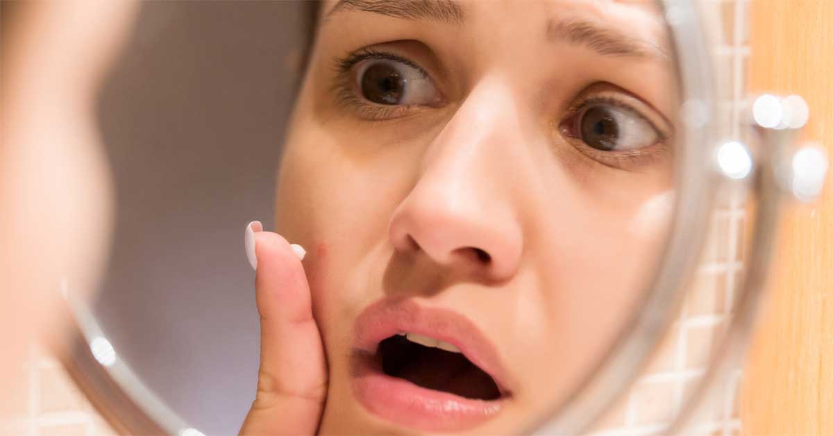 flogocid za bubuljice