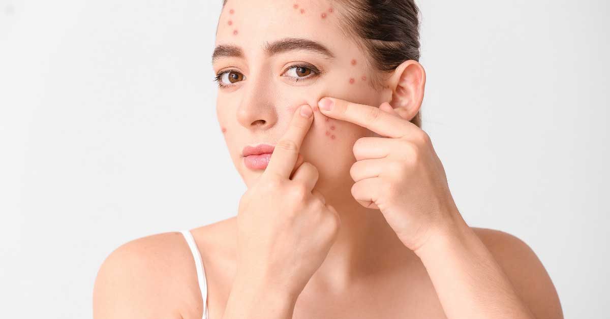  Papule na licu su uporne, ali nisu nepobedive!