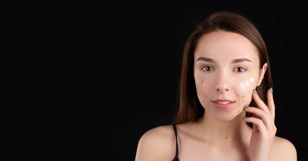 krema za ožiljke od akni