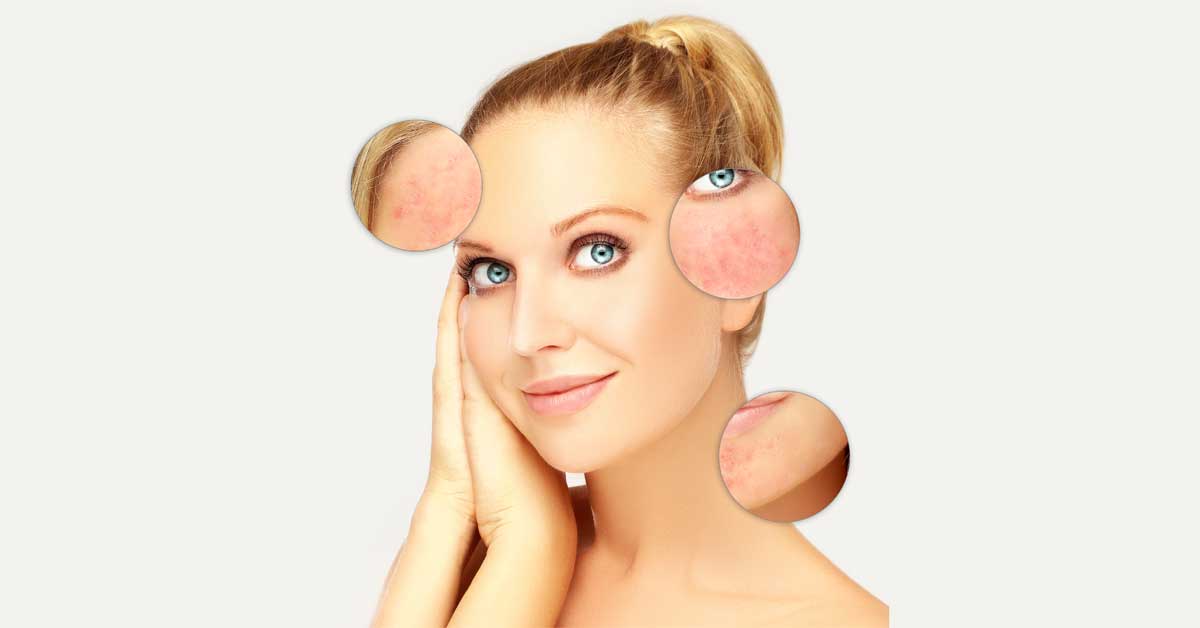  Načini da rozacea na licu nestane!