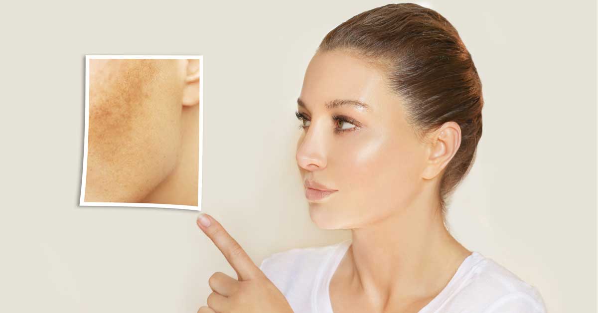  Hiperpigmentacija na licu i kako da je se rešite