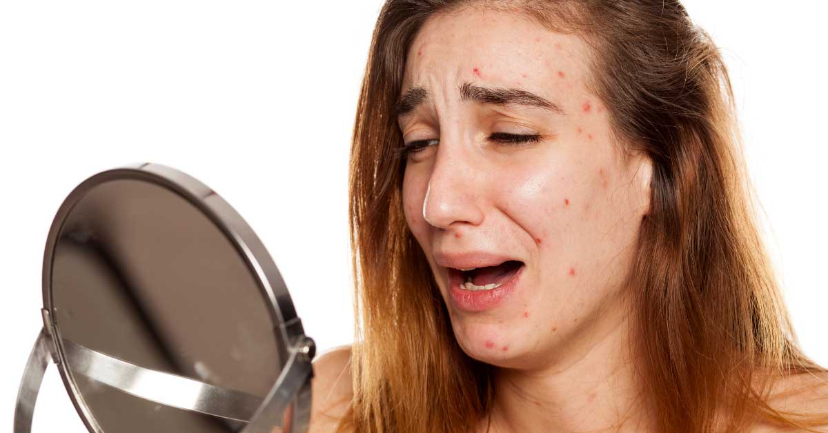 problematična koža lica