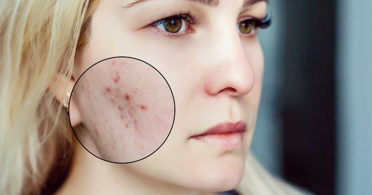 koža sklona aknama