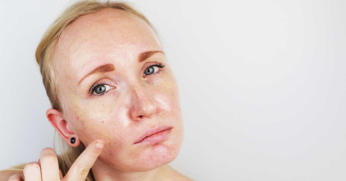  Lojne žlezde i njihov uticaj na kožu lica