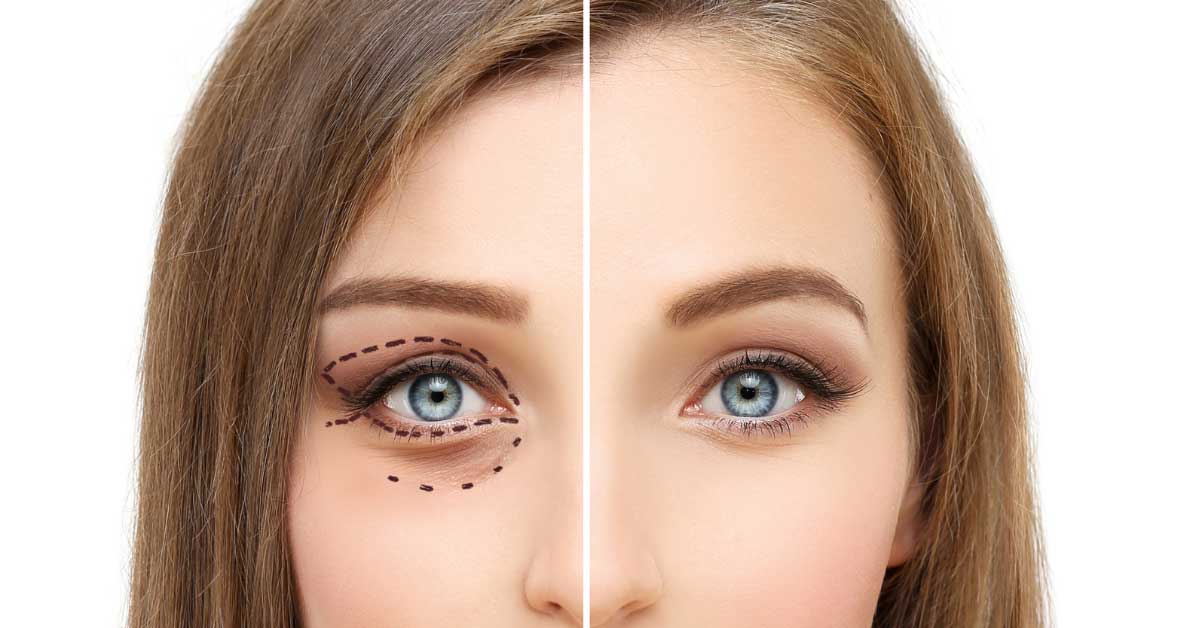 operacija podočnjaka