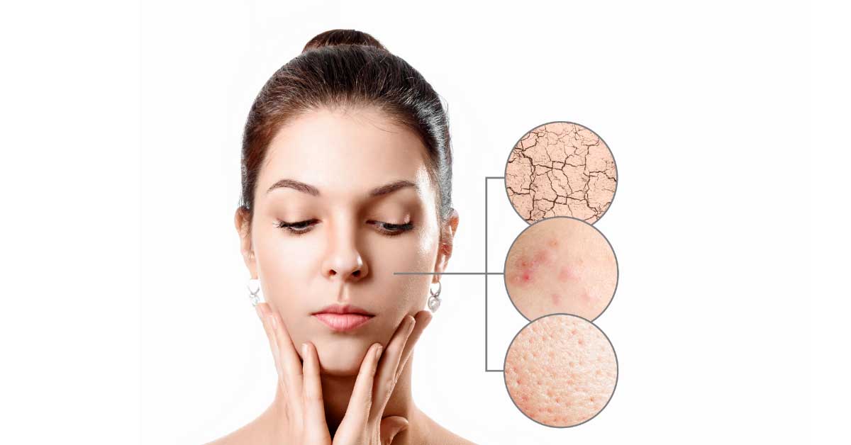  Suva koža sklona bubuljicama – saveti za negu