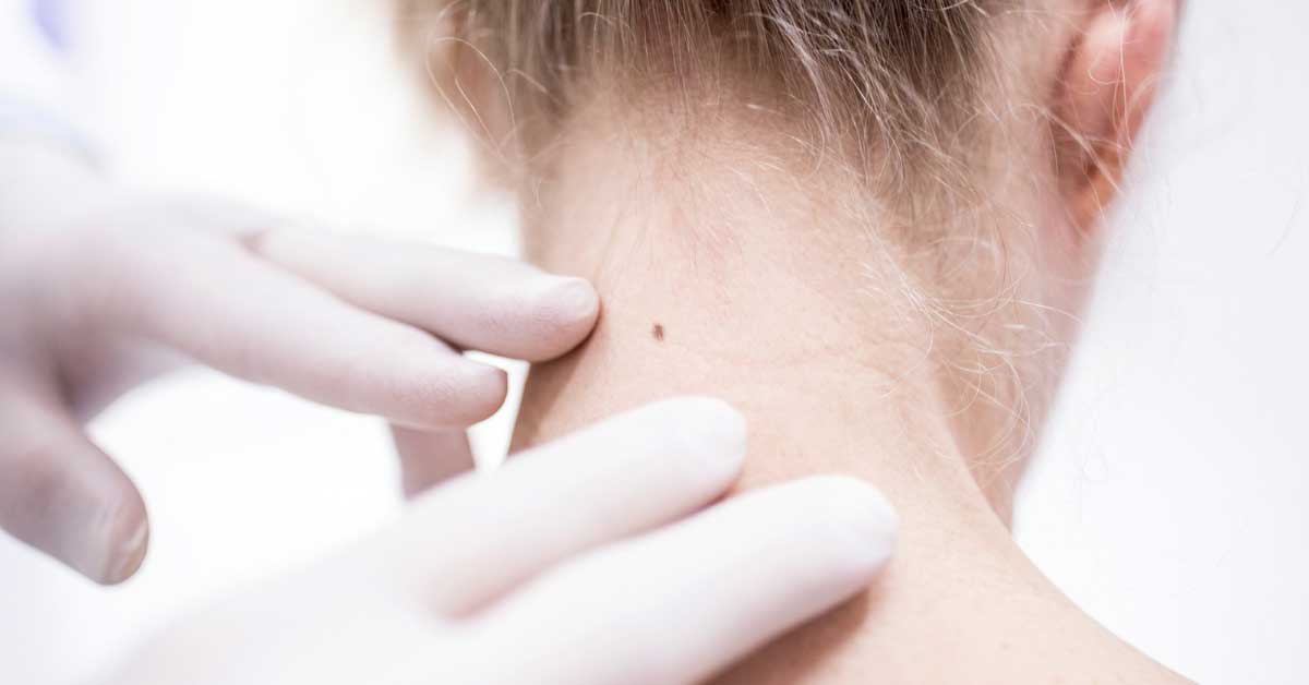 bubuljica na mladežu