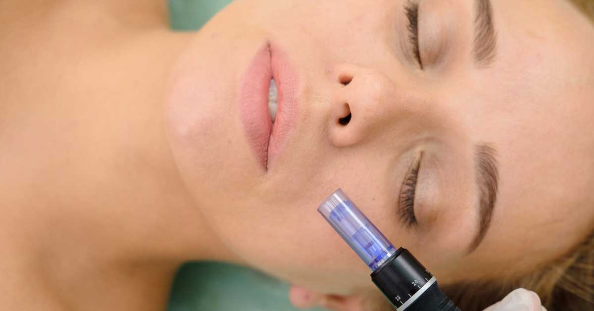  Šta microneedling tretman lica  čini za kožu?