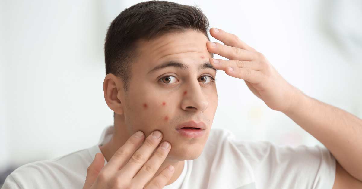 steroidne akne na licu